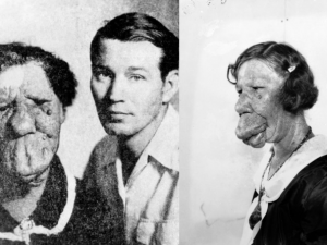 Grace McDaniels trpěla vzácnou vadou, která způsobila neobvyklý otok jejího obličeje. Byla několikrát vdaná a porodila syna