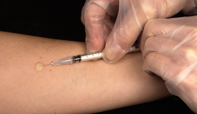 Epidemie žloutenky trvá na severu Moravy už rok. Hygienici hlásí 289 nakažených