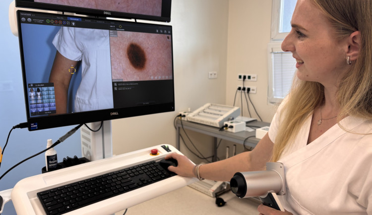 Ilustrační foto dermatoskopu. Foto: Se svolením Nemocnice Jihlava