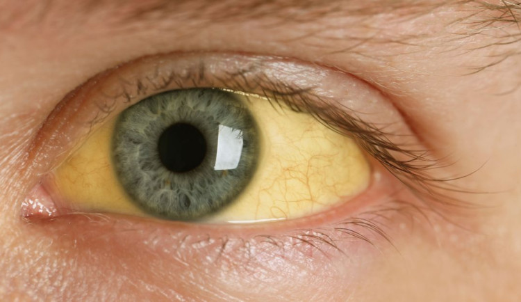 V kraji se letos objevily dva případy žloutenky