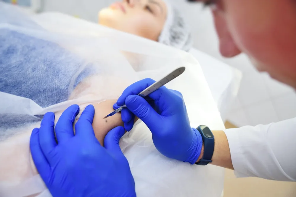 Nechte si po létu zkontrolovat znaménka, doporučují dermatologové